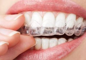 Night-Guard-for-Teeth-Grinding-Treatment-450x450